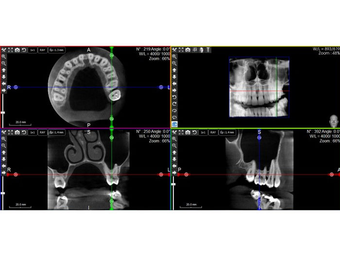 Image CBCT radioprotection dentaire