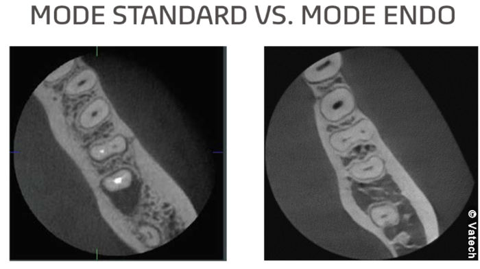 Mode endo - © Vatech